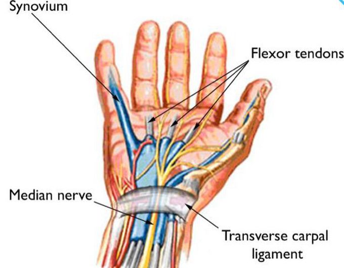 Carpal tunnel syndrome