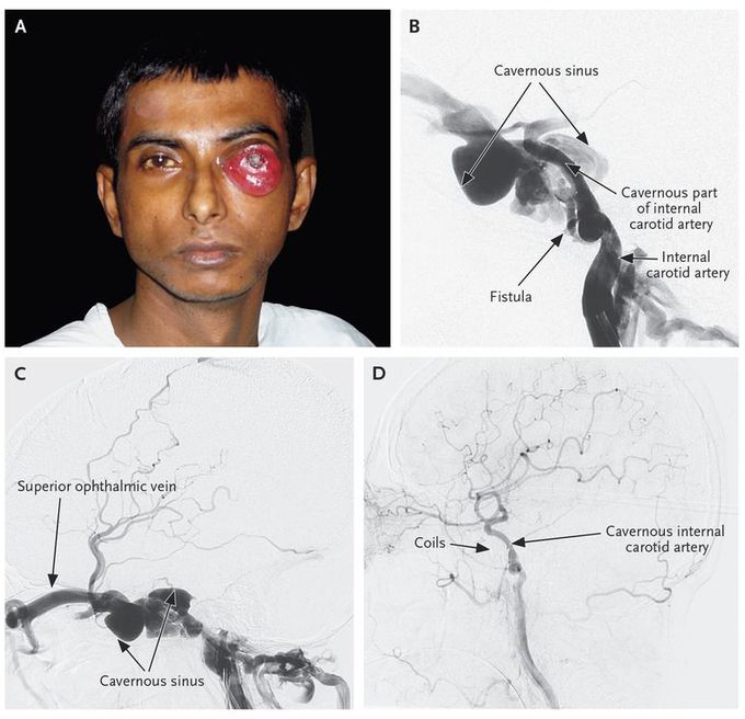 Carotid Cavernous Fistula