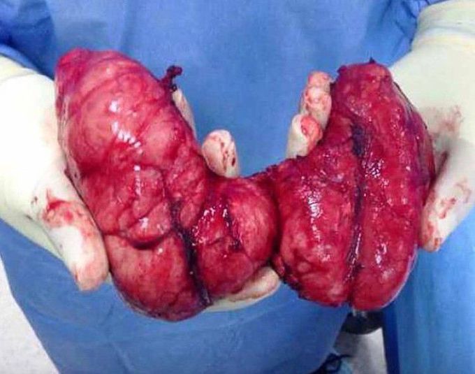 Thyroid glands with goiter