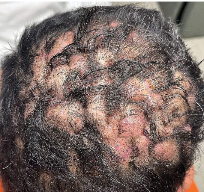 Dissecting Cellulitis of the Scalp