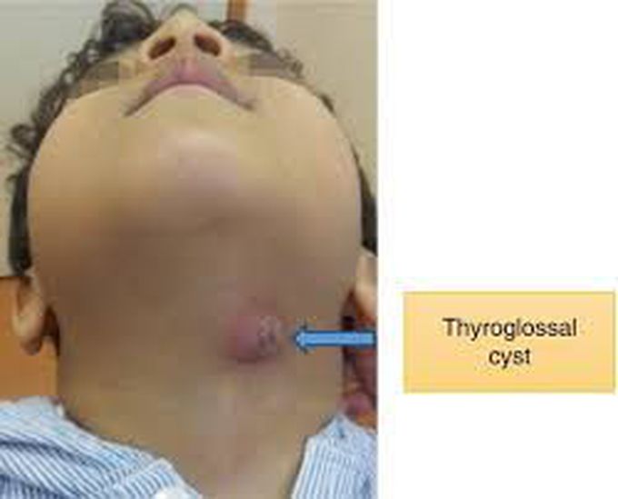 Symptoms of thyroglossal duct cyst