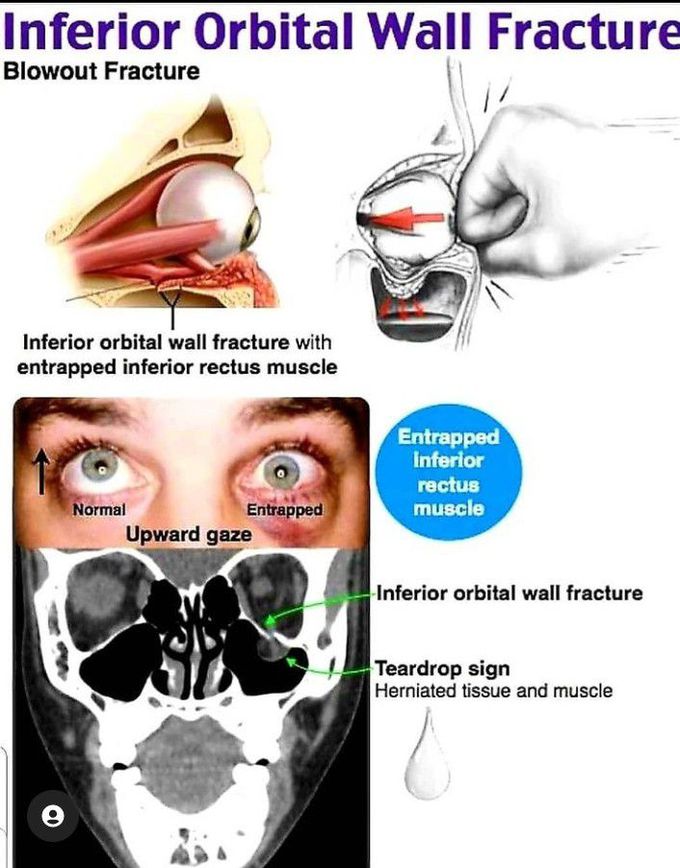 Inferior orbital wall fracture
