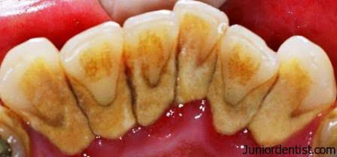 Subgingival calculus