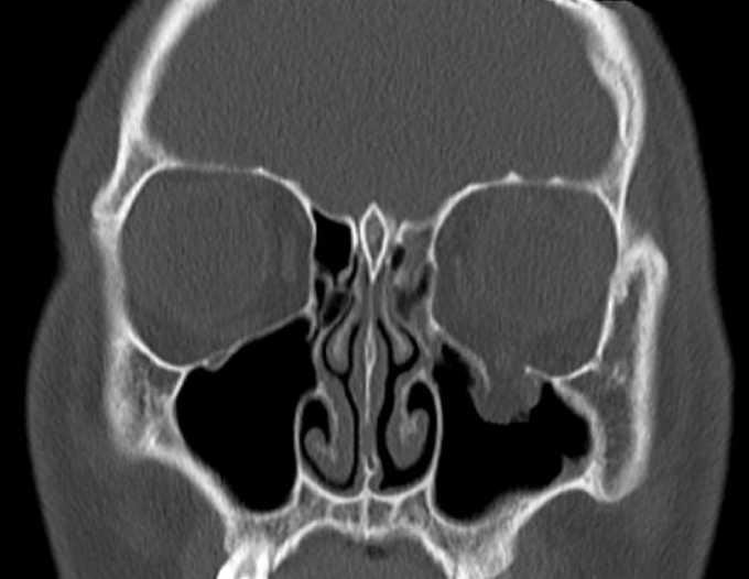 Orbital Floor Blowout Fracture