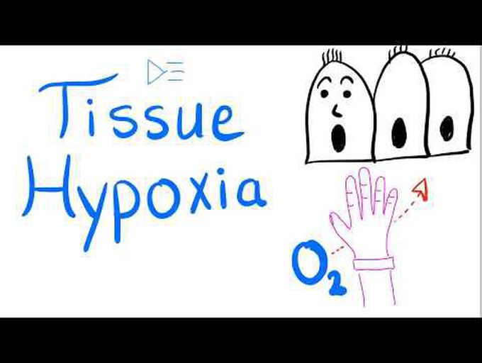 Tissue Hypoxia:
Understanding key concepts