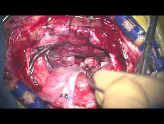 Resection of large recurrent 3rd ventr epidermoid tumors thru the post interhemi transcallosal appr