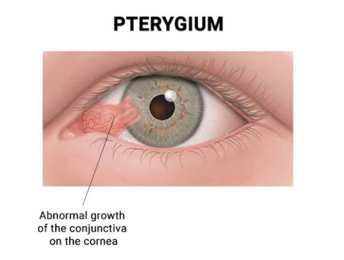 Cause of Pterygium