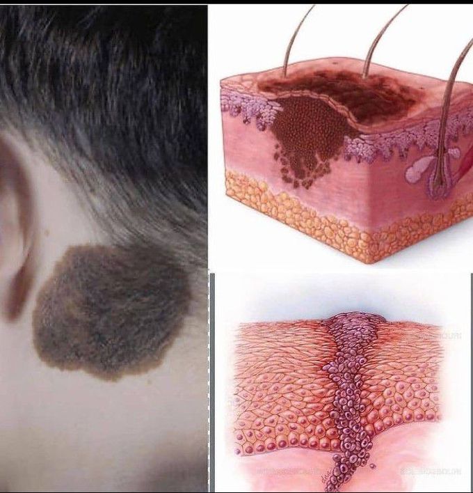 MELANOMA