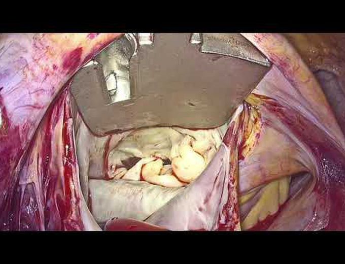 Totally Endoscopic Mitral Valve Repair With Predetermined Length of Synthetic Chordae