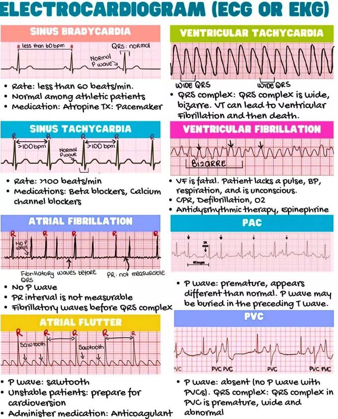 Electrocardiogram