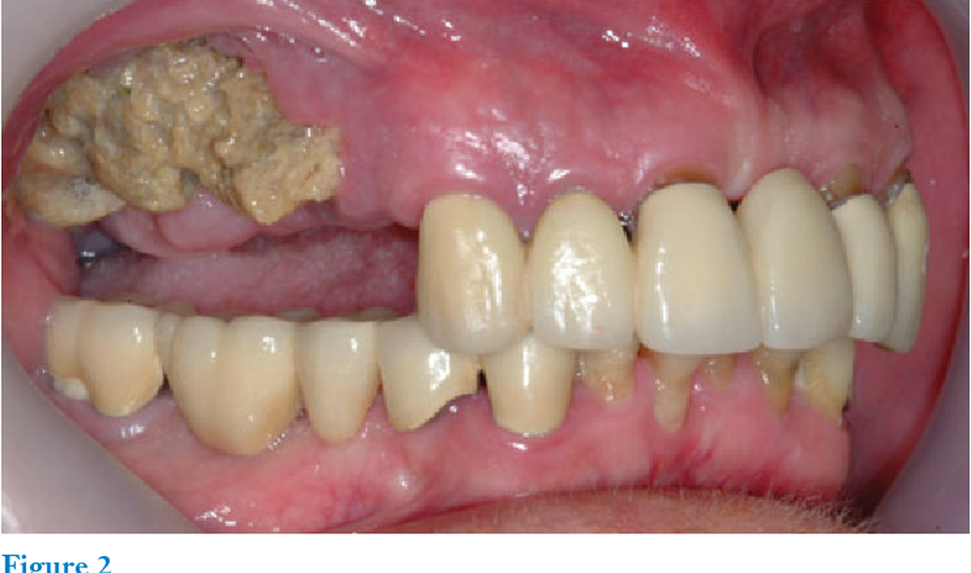 Bisphosphonates- the dreaded complication - medizzy