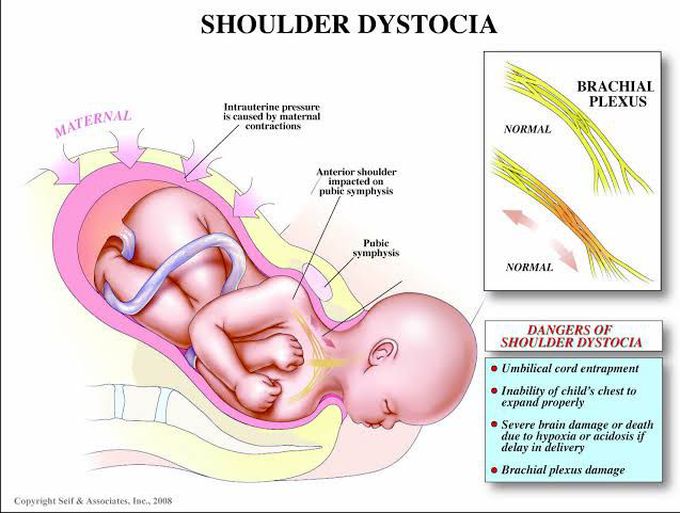 Shoulder dystocia