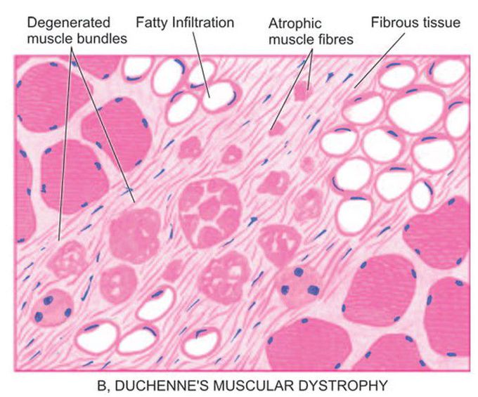 Duchenne's muscular dystrophy