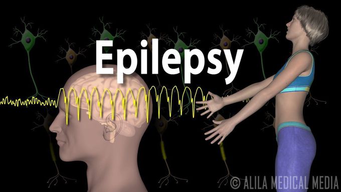 Epilepsy (Animation)