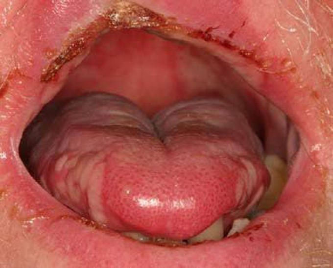 what causes mucositis