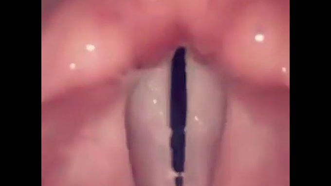Vocal cord action amazing capturing