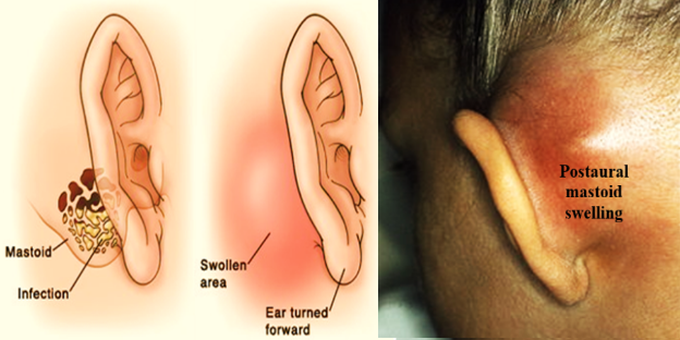 mastoiditis symptoms