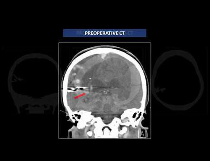Microsurgical mgmt of a high-grade brain AVM in the central lobe after unsuccessful radiosurgery