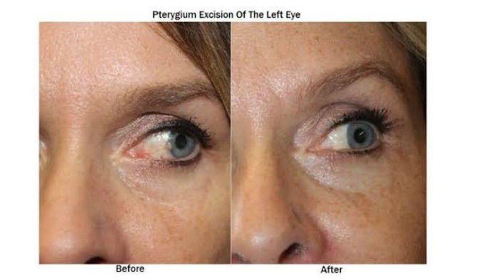 Treatment for pterygium