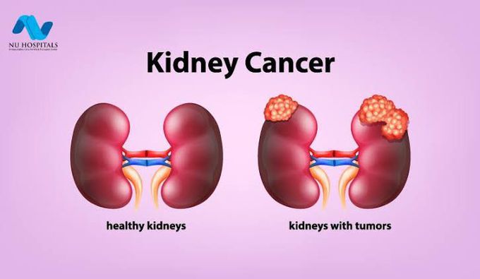 Symptoms of kidney cancer