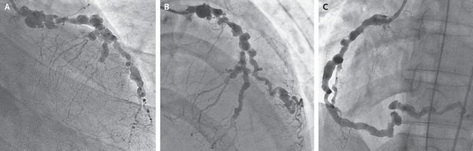 Coronary Arteritis
