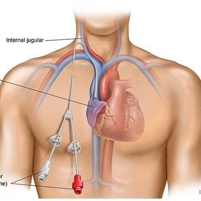 Central venous catheters (cvc)