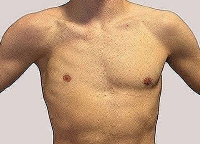 Poland syndrome