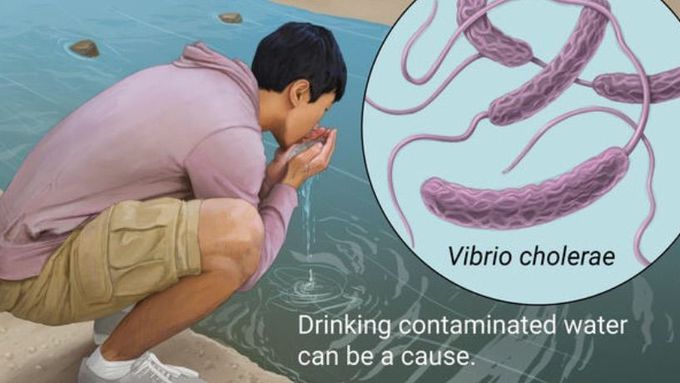 Vibrio Cholera