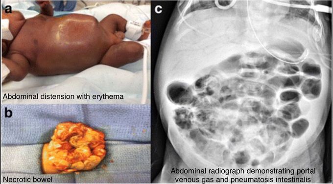 Necrotizing enterocolitis
