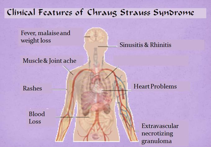 Churg Strauss Syndrome