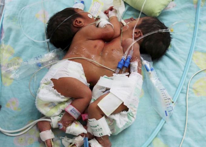 Conjoined twin girls born in İndia
