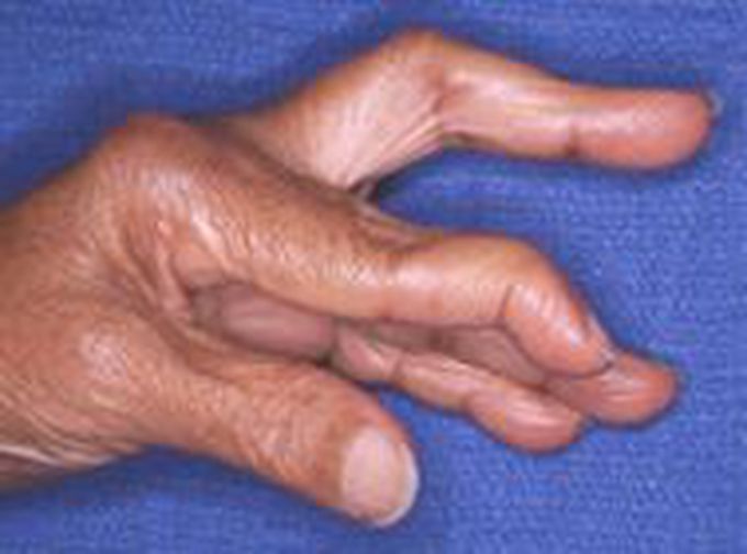 Swan Neck Deformity