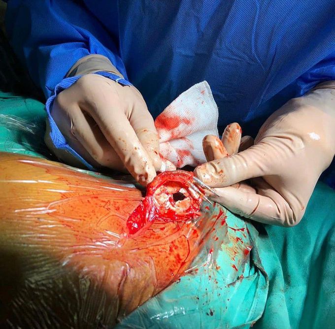 Ever seen a calcified pacemaker? 