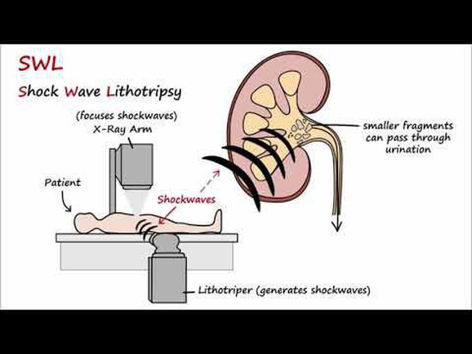 Nephrolithiasis