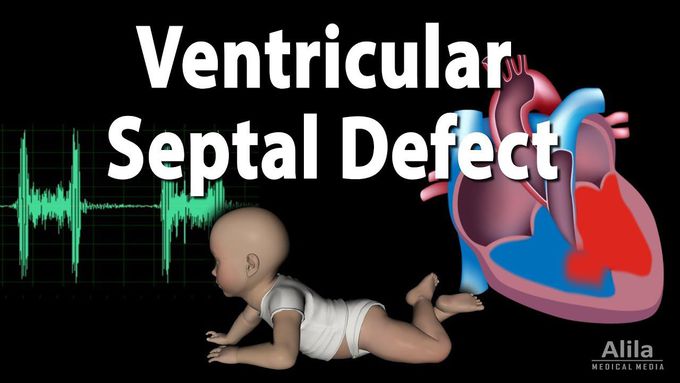 Ventricular Septal Defect, Animation - MEDizzy