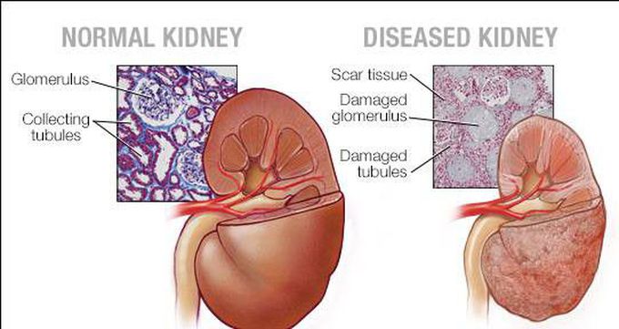 Treatment for Chronic Kidney Disease