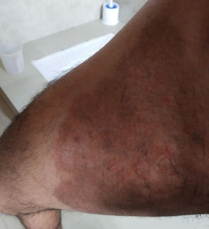 Chronic Fungal infection