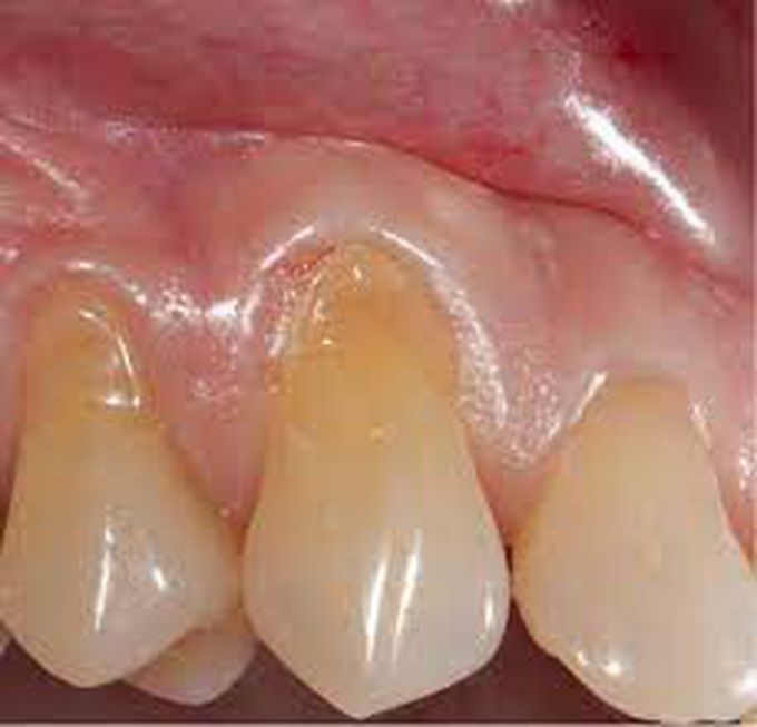 Treatment of dental abrasion
