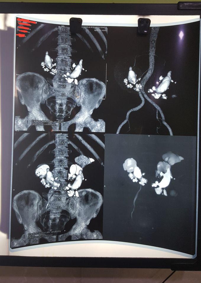 Multiple large renal pelvic and calyceal stones .