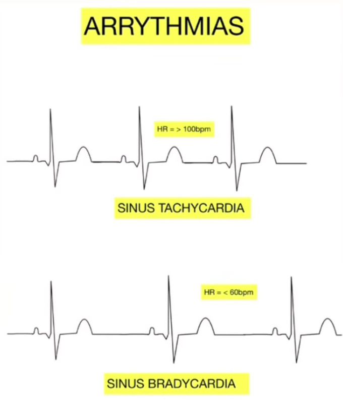 Sinus Tachycardia and Bradycardia