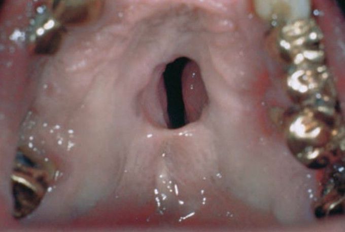 Tertiary syphilis oral lesion