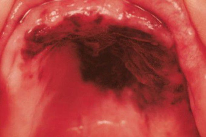 Invasive oral melanoma