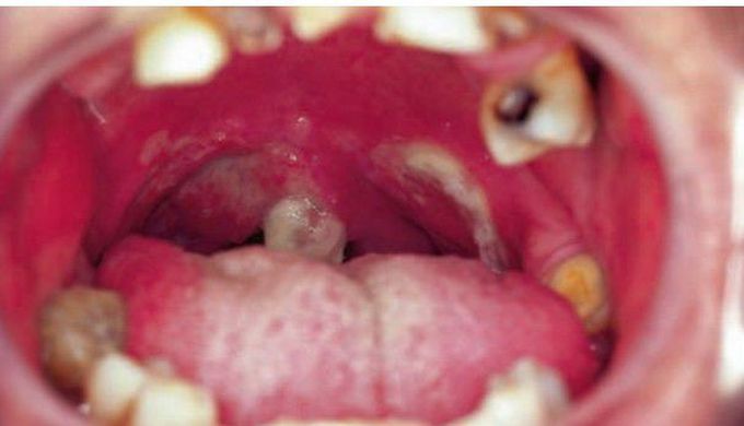 Ulcerating midline granuloma