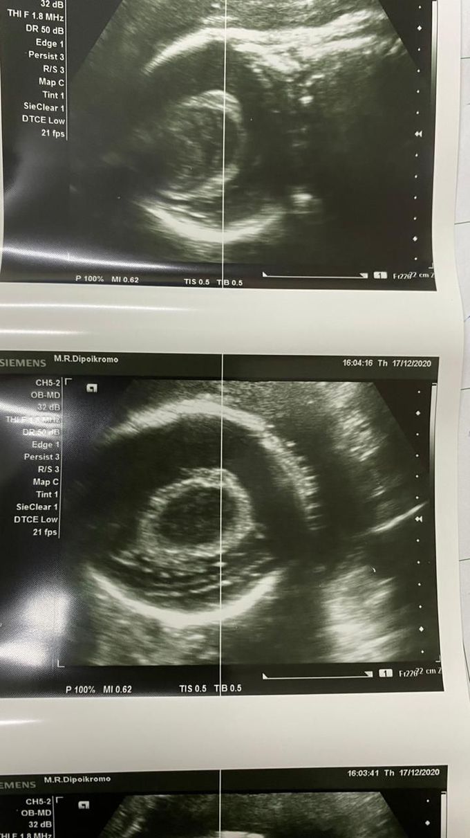 Head circumference echography of 32 week old fetus.