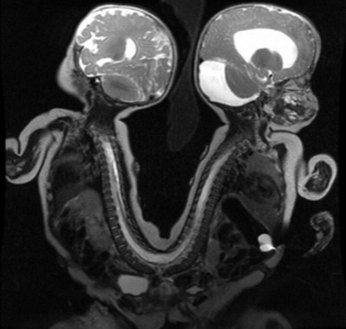 Conjoined twins MRI