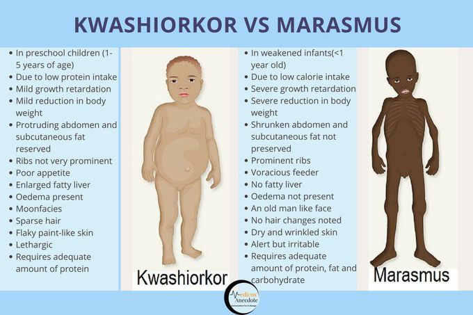Disorders of the Malnourished World- Kwashiorkor vs Marasmus