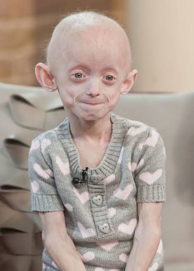 Progeria