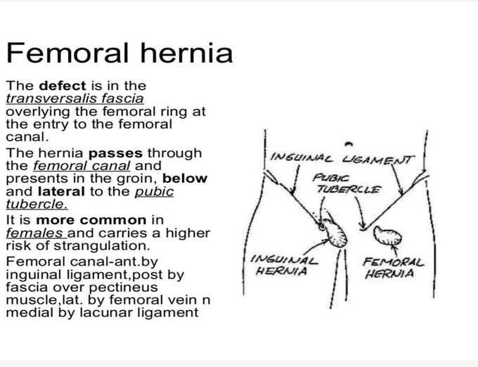 Femoral Hernia