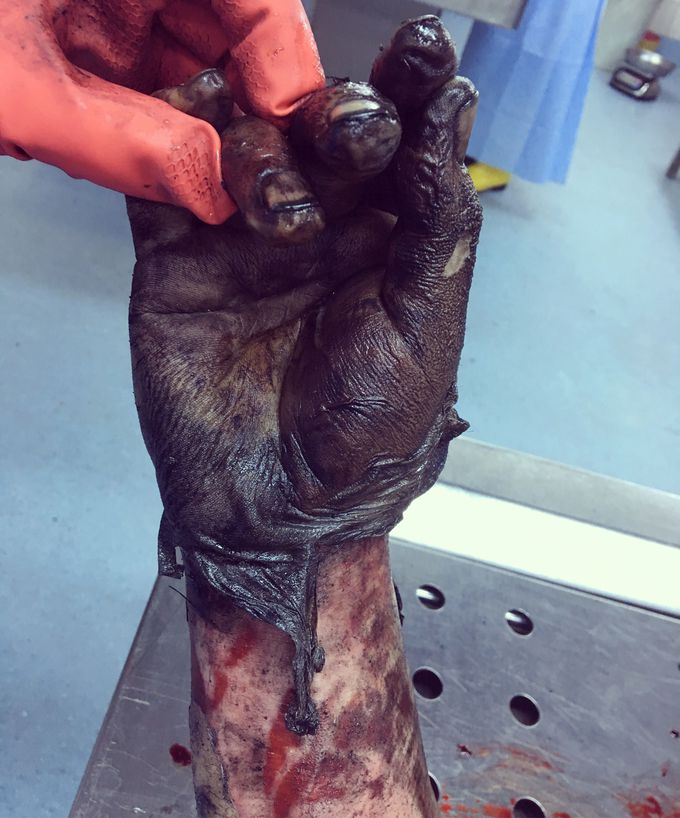 After explosion, burn injuries