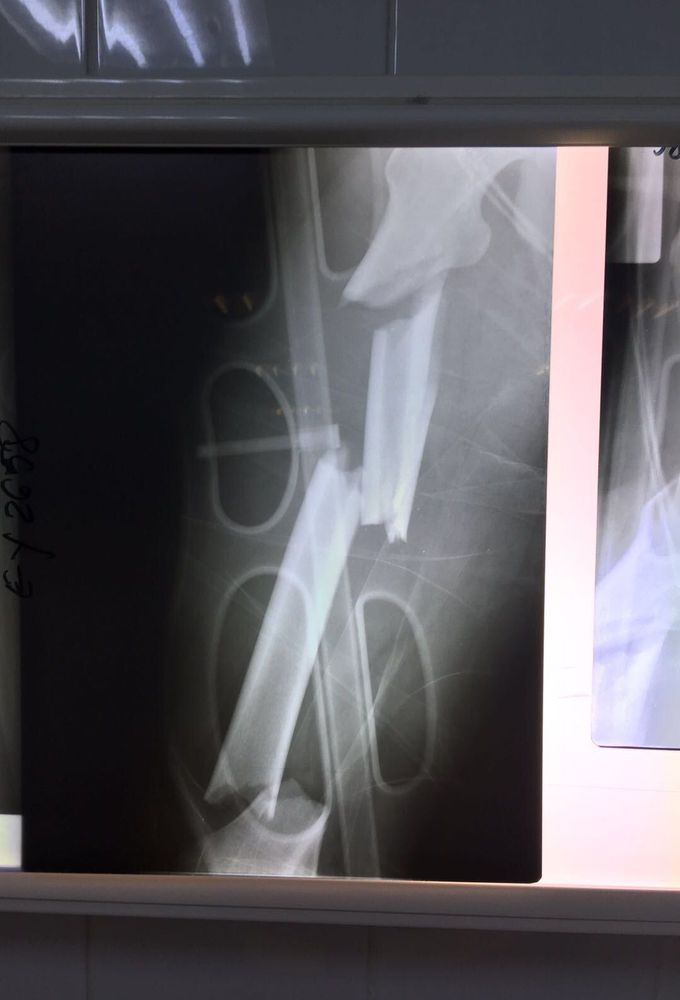 Femur fracture